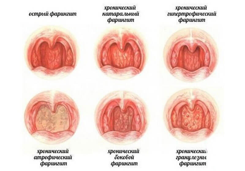 Как Выглядит Горло Человека Фото