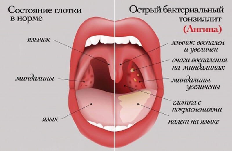 Как за 2 дня вылечить горло без лекарств: народные средства