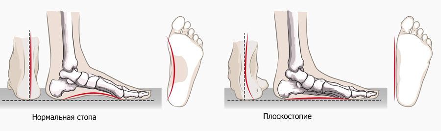 Как подобрать ортопедические стельки