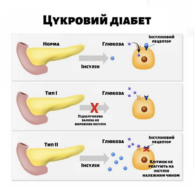 Як знизити цукор у крові