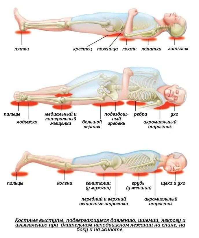Костные выступы, подвергающиеся давлению, ишемии, некрозу и изъязвлению