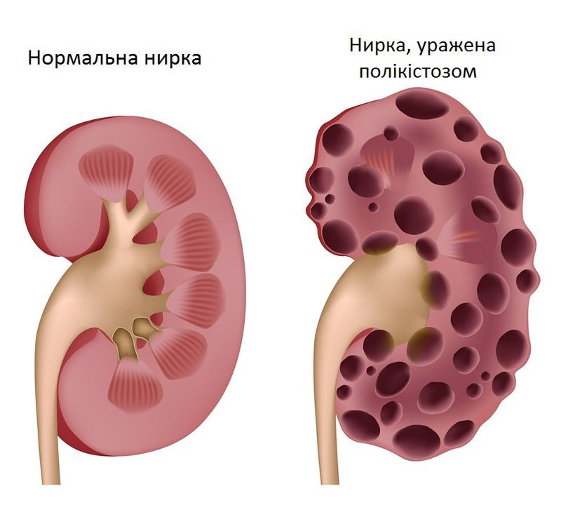 Симптомы болезни почек у женщин