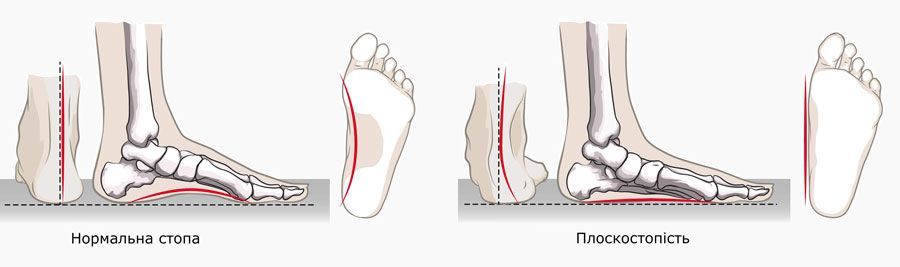 Як підібрати ортопедичні устілки