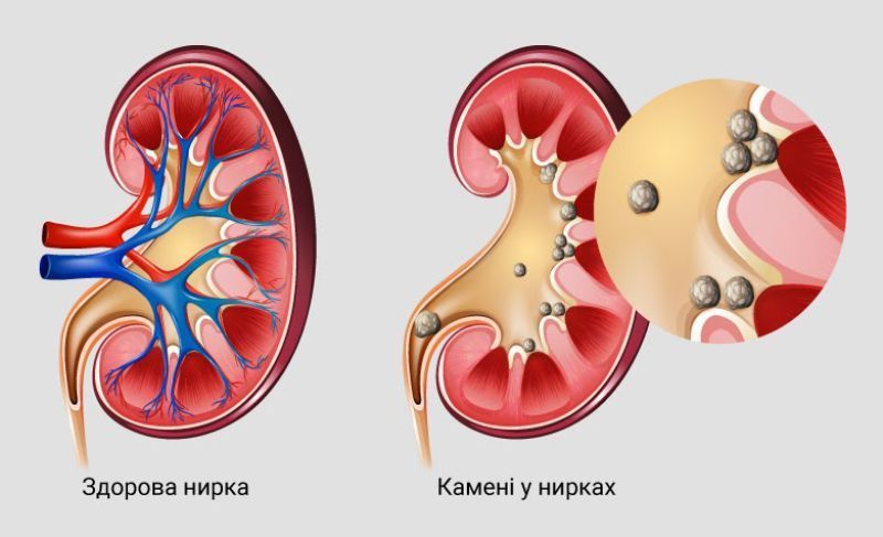 Захворювання нирок