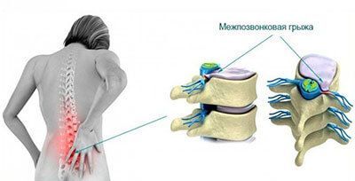 как выглядит межпозвоночная грыжа