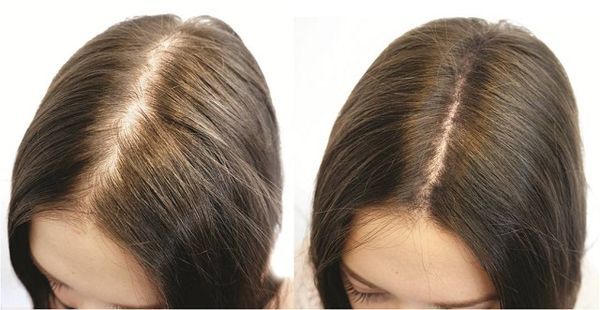 дарсонвализация волос - фото до и после